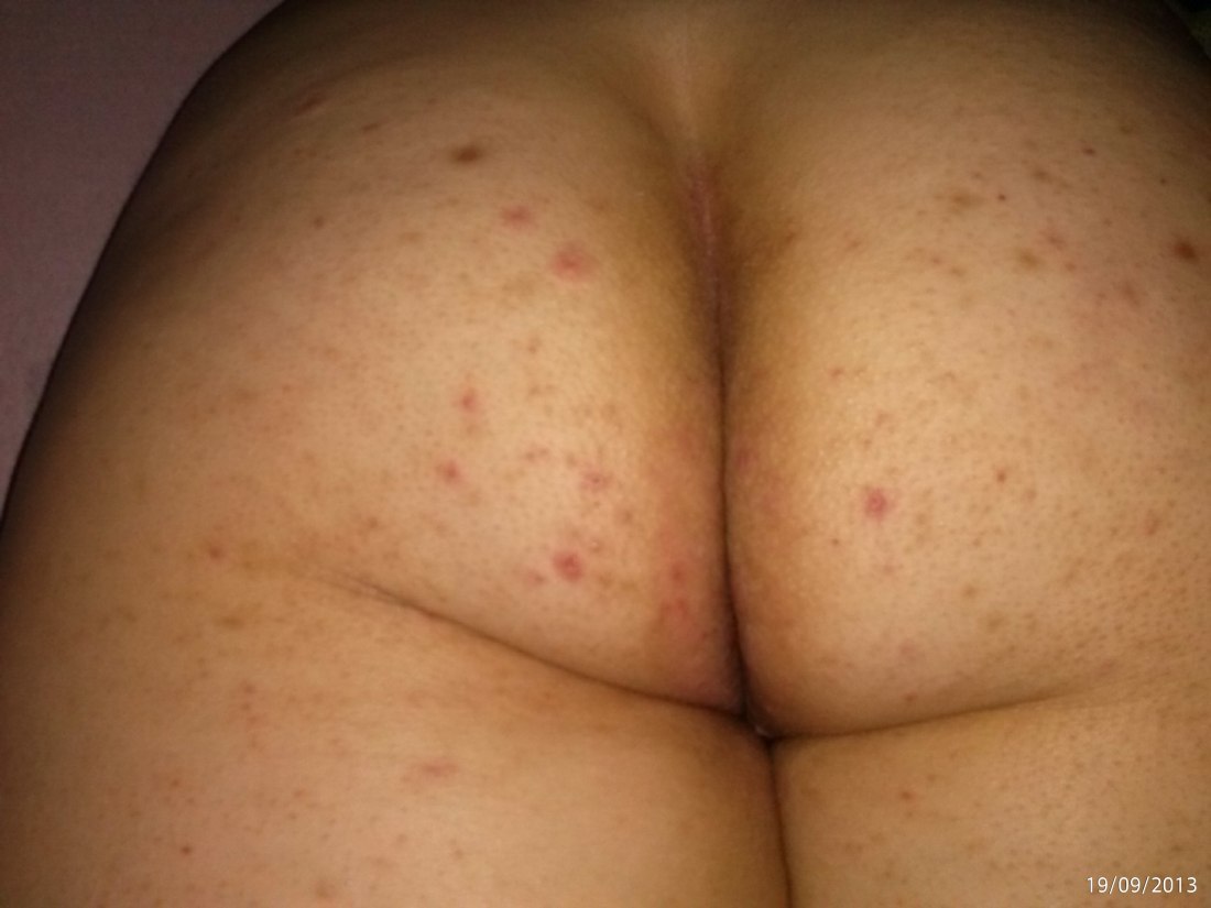 Прыщавая женская попка