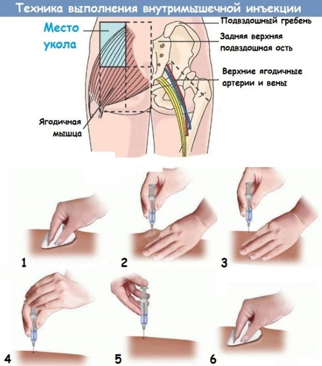 Правильно поставить укол внутримышечно