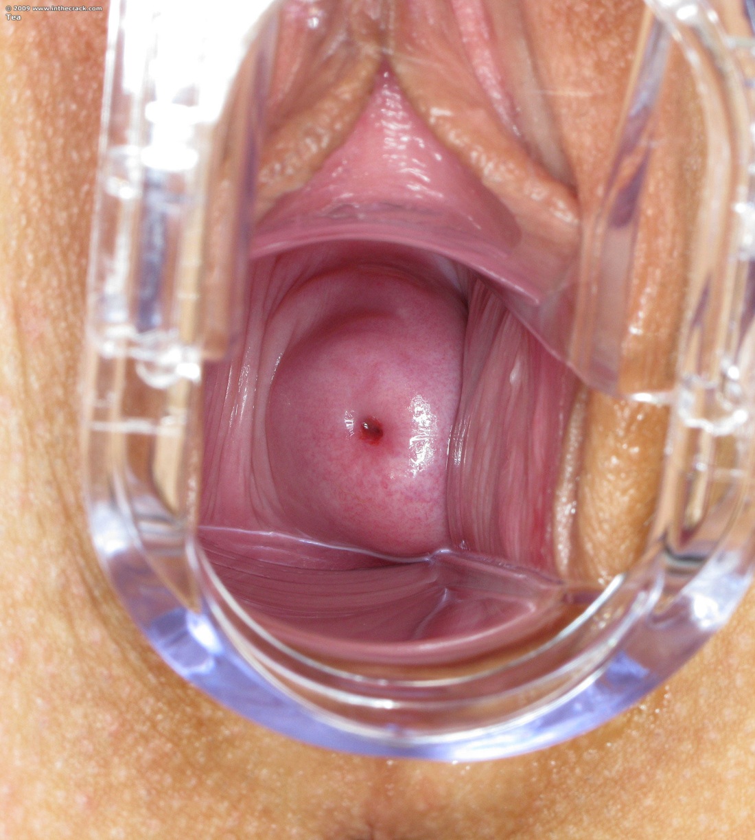 Влагалище здоровой женщины