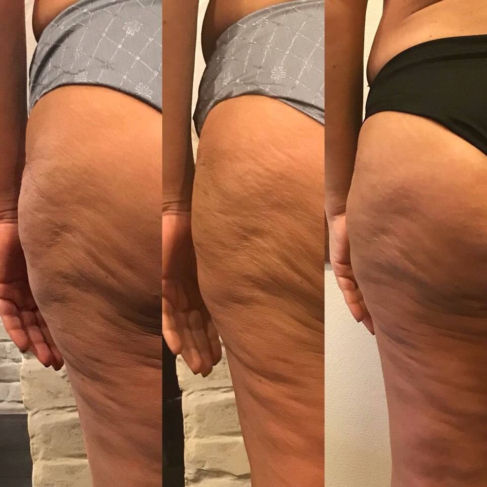 Антицеллюлитный массаж