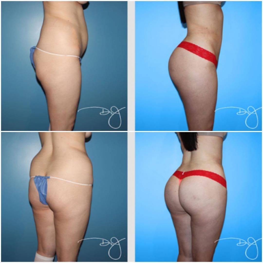 Увеличение попы