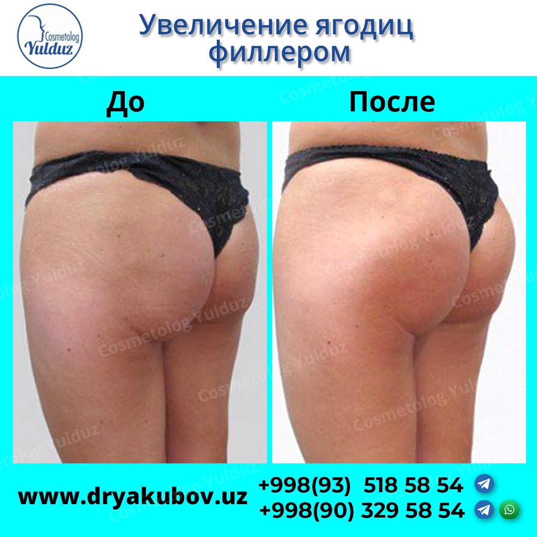 Увеличение ягодиц гиалуроновой кислотой