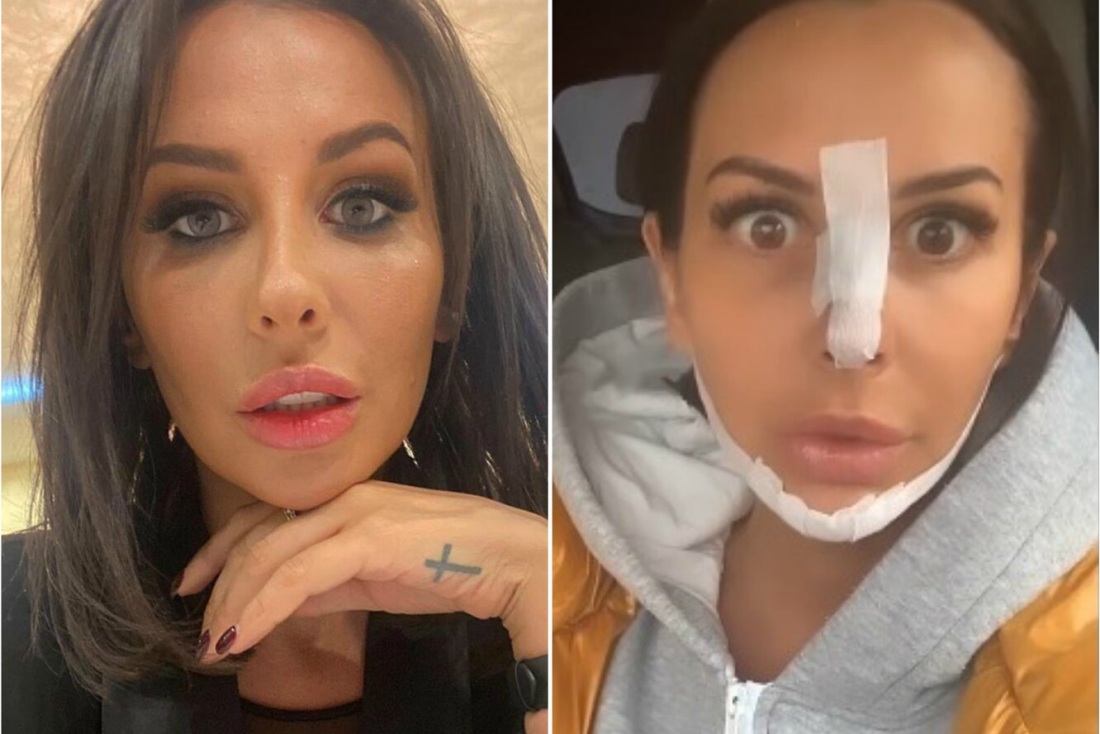 Анна Грачевская до пластики