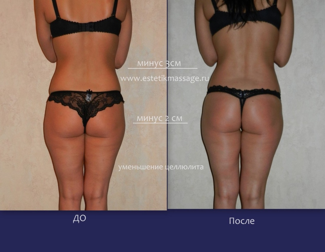 Антицеллюлитный массаж щеткой сухой до и после