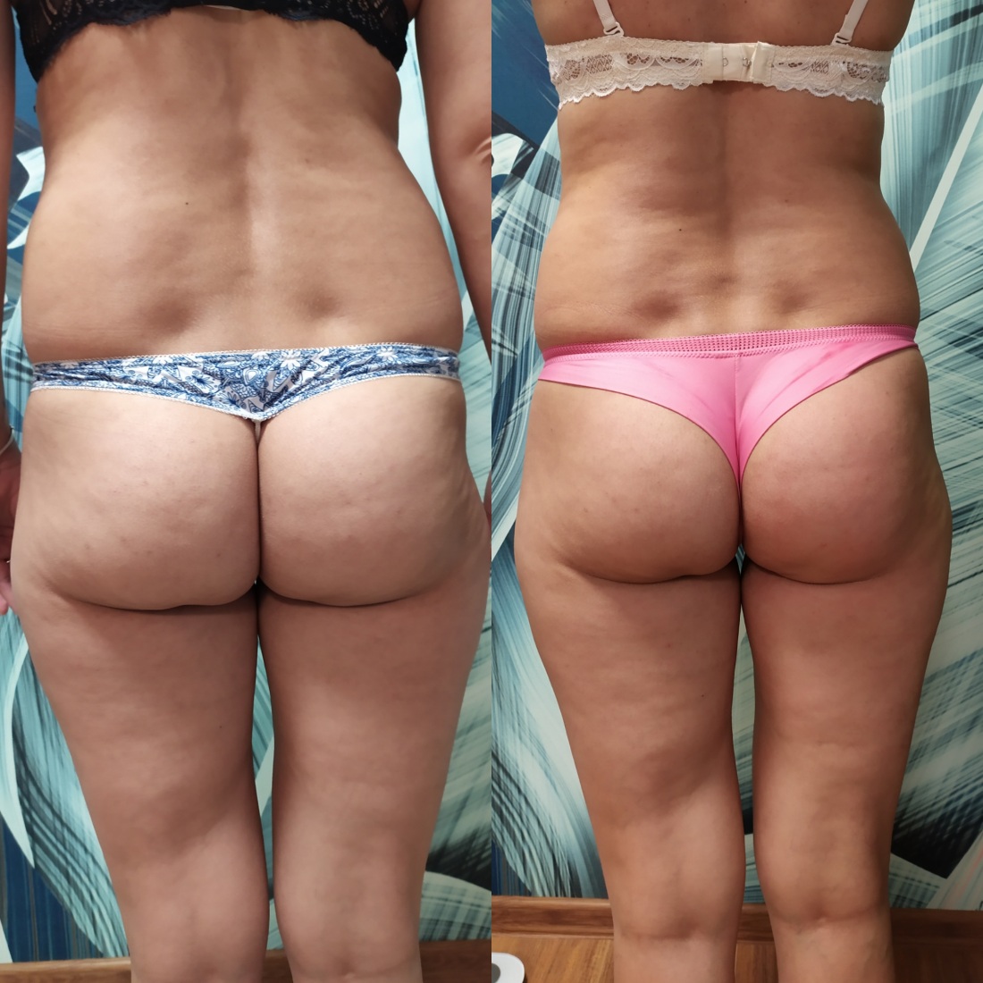 Эндосфера до и после