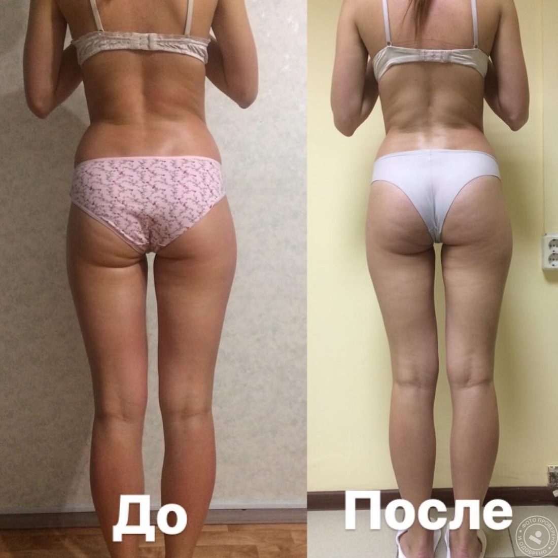 Эффект после антицеллюлитного массажа