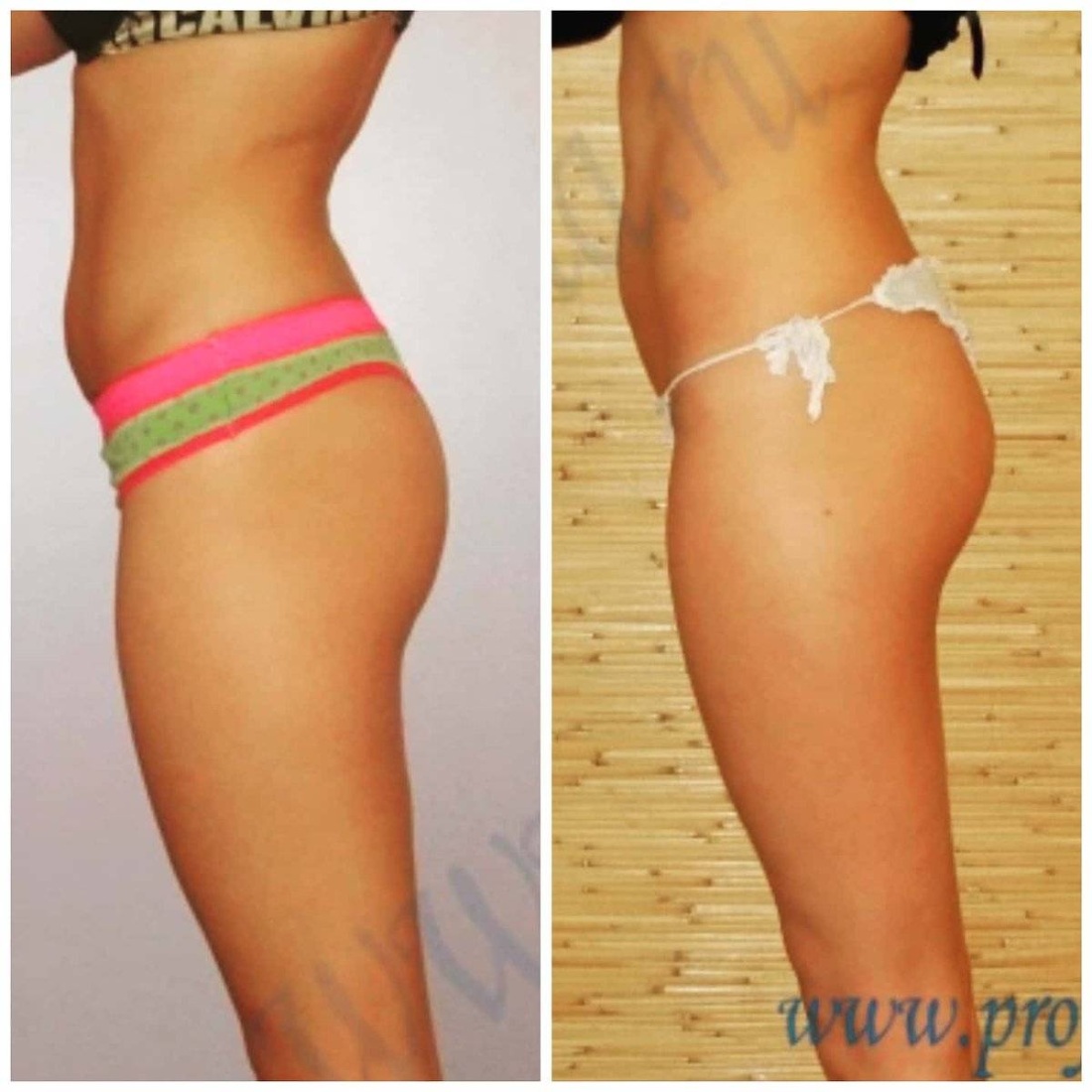 Липофилинг ягодиц Свиридов