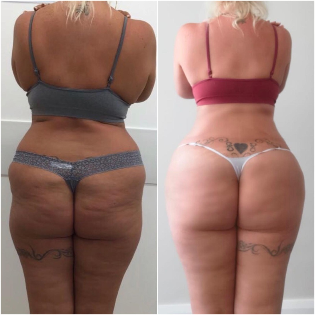 Липомоделирование ягодиц