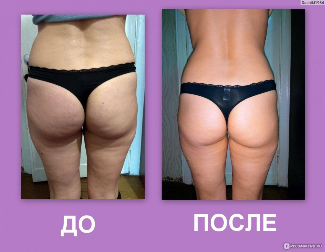 Антицеллюлитный массаж до и после