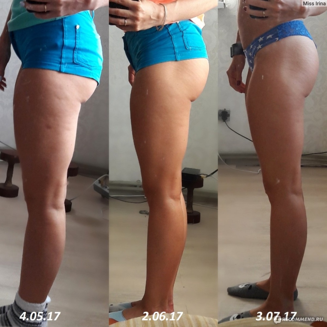 Целлюлит до и после