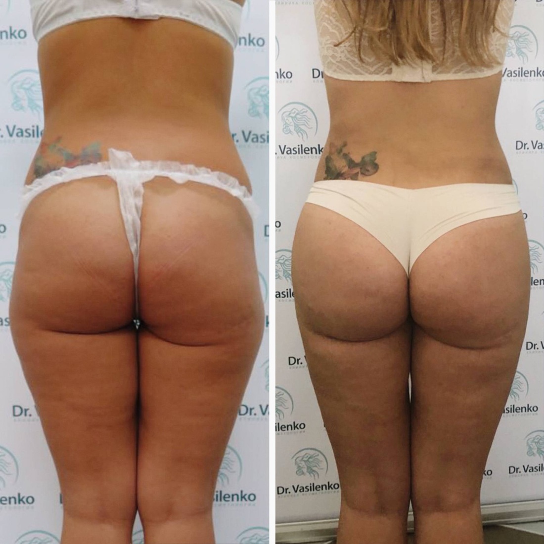 Липофилинг бедер и ягодиц