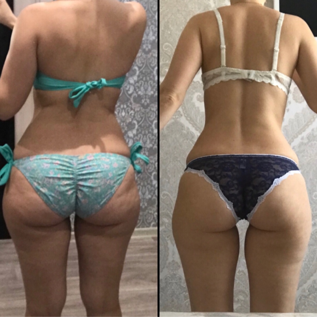 Целлюлитные ноги и ягодицы