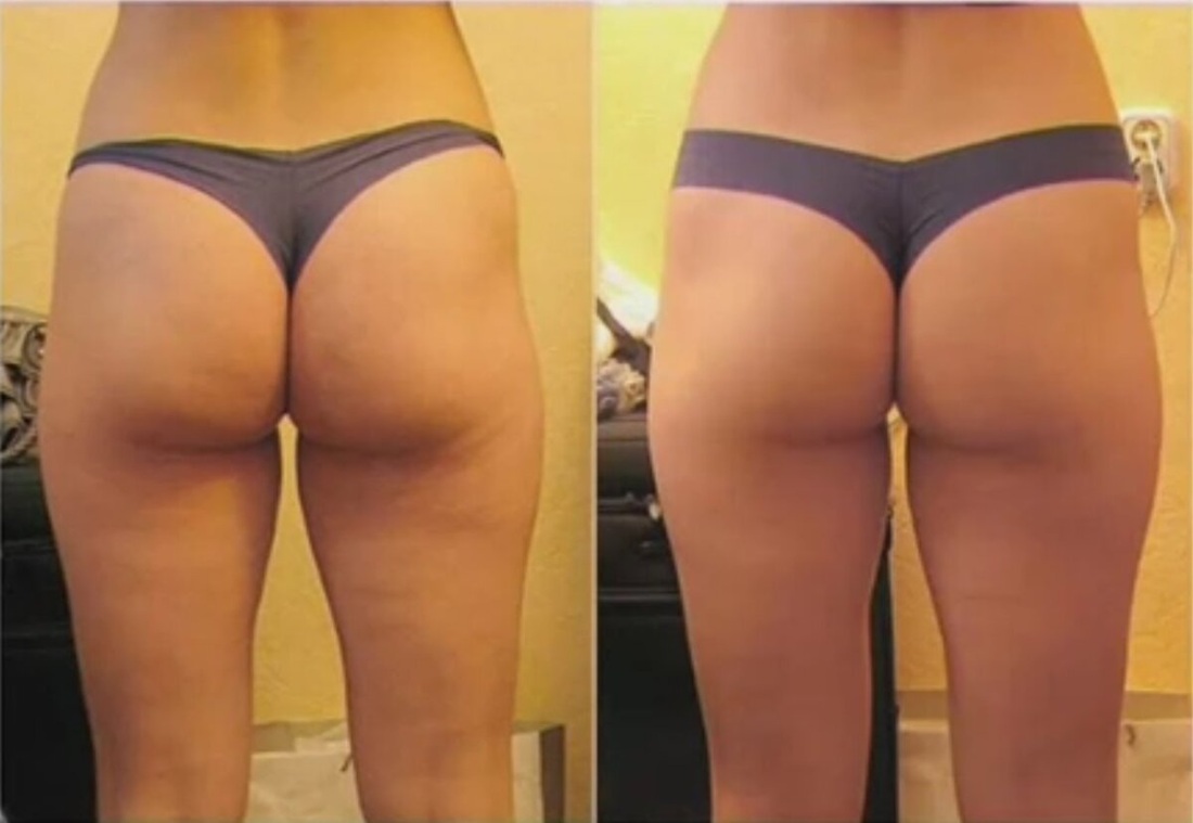 Целлюлитные ноги и ягодицы