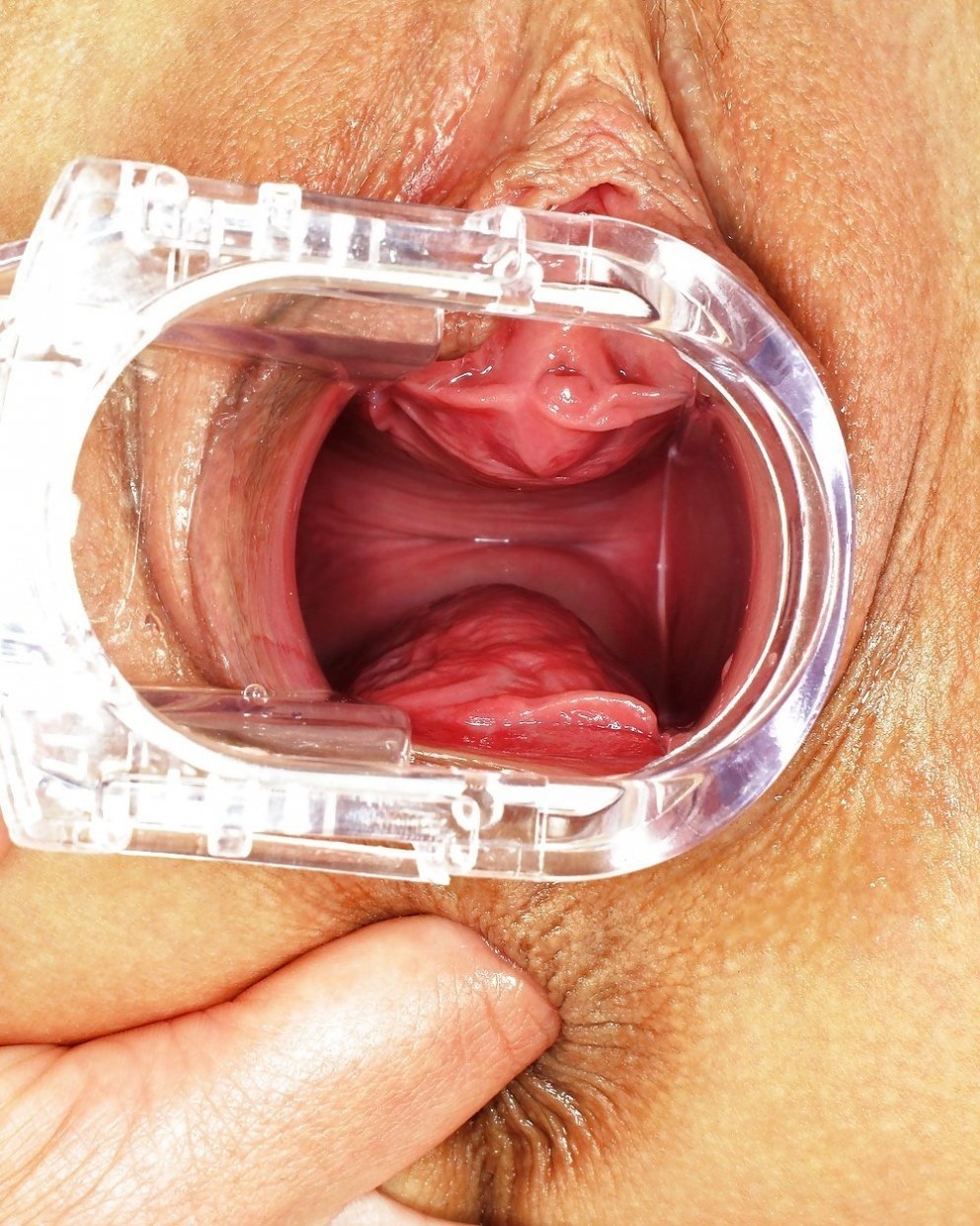 Расширитель внутри влагалища