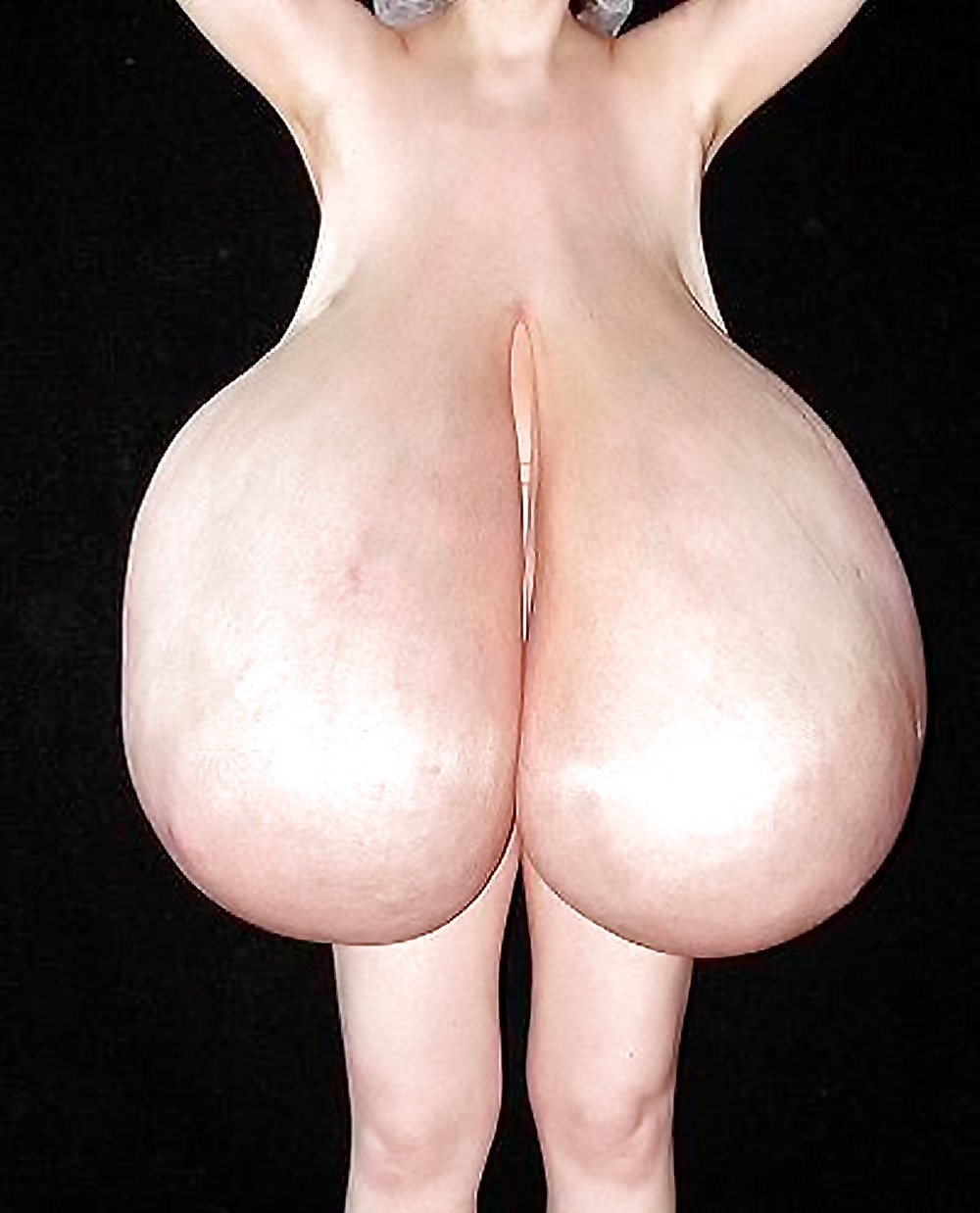 Гипермастия макромастия