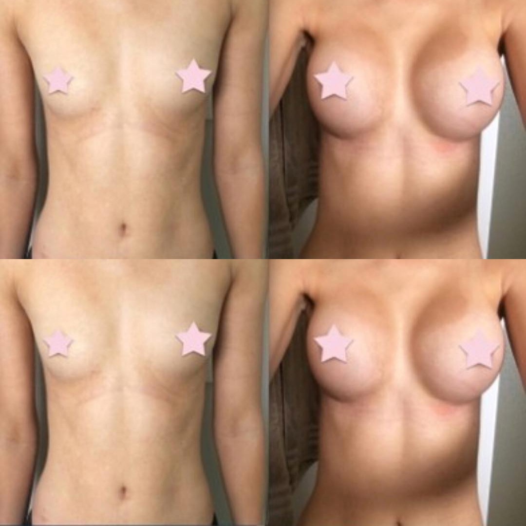 Увеличила сиськи до и после