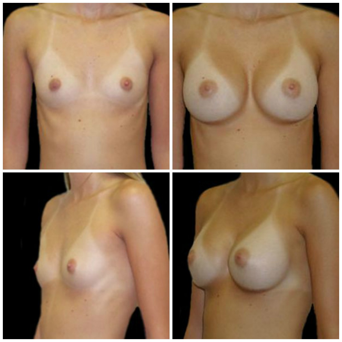 голая грудь после родов фото до и после фото 92