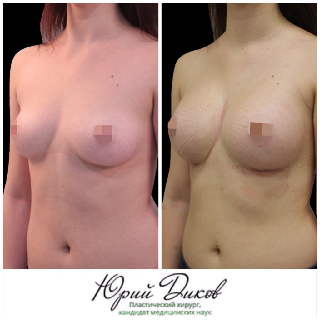 Пластика груди до и после