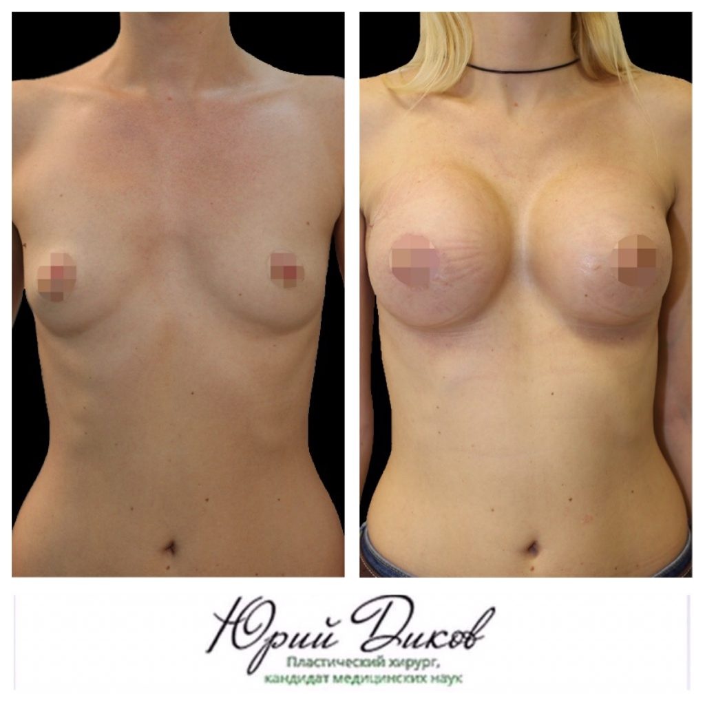 Голая грудь после родов