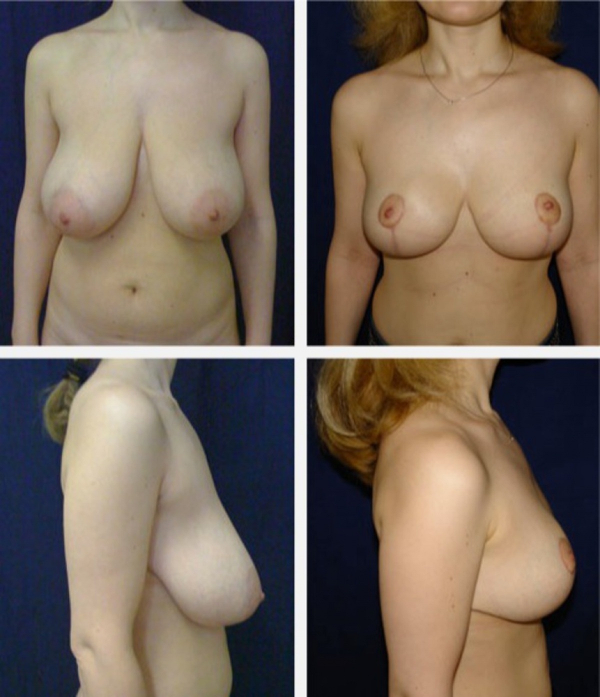 уменьшение груди у женщин фото 96