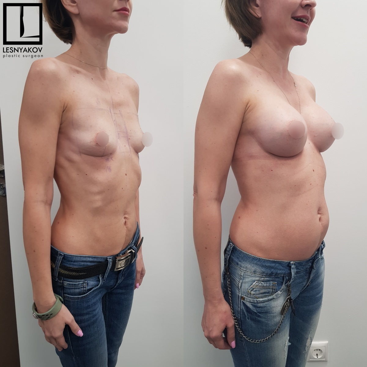 силиконовая грудь до родов фото 3