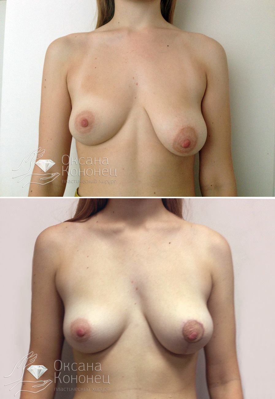 Маммопластика до после