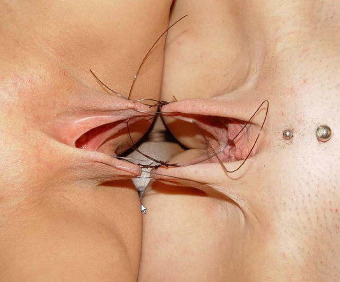 Зашивание влагалища бдсм