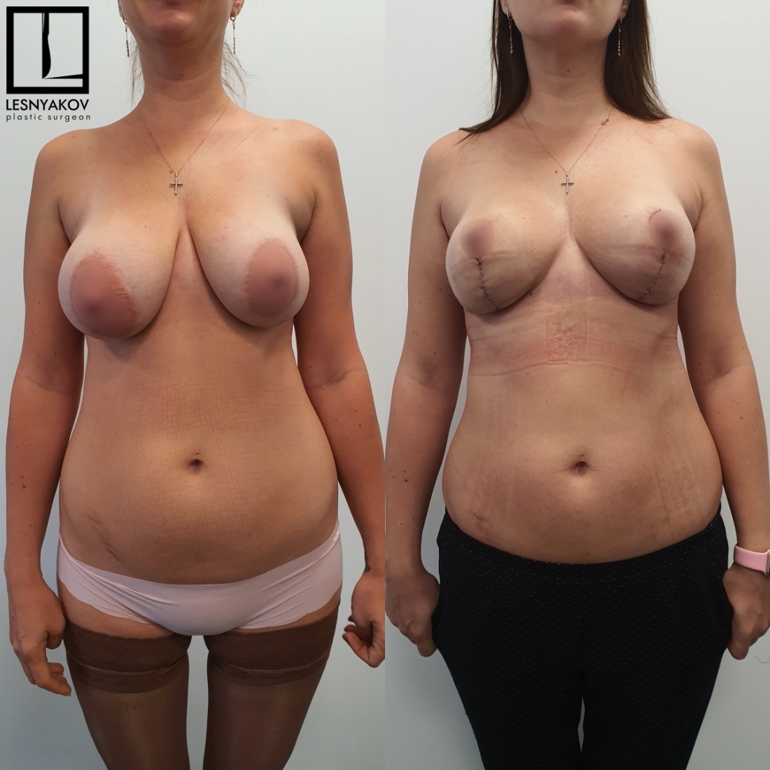 Пластика груди до и после