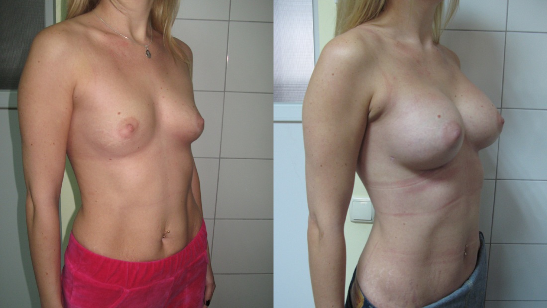 Очень большая грудь пластика голые