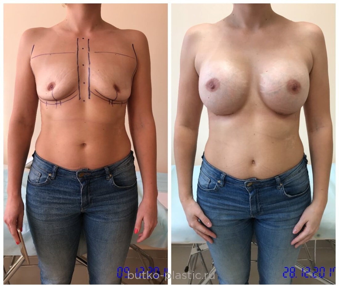 Грудь у транссексуалов после гормонов