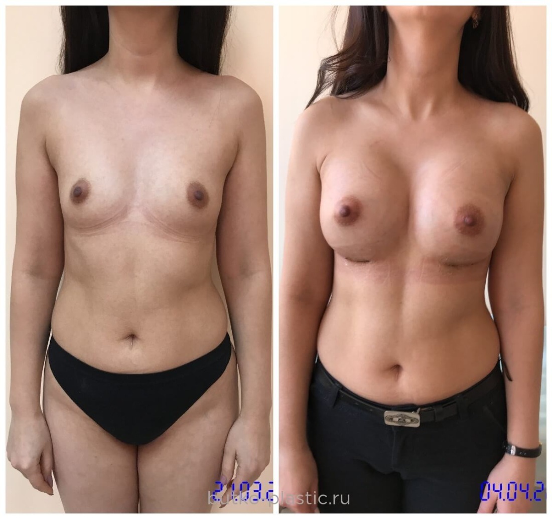 Силиконовая грудь операция