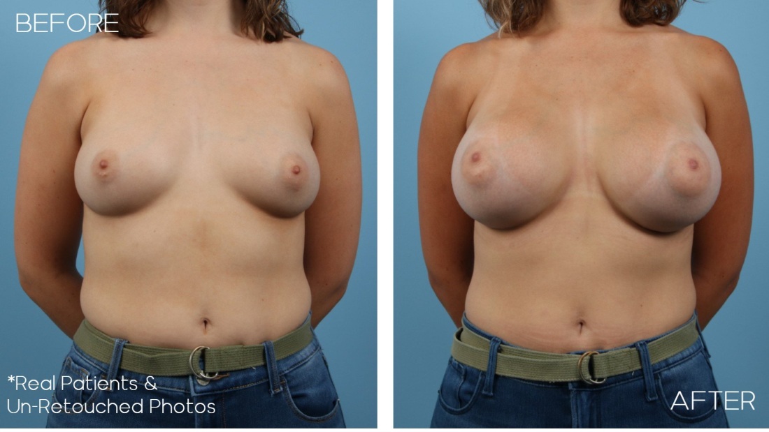 Силиконовые сиськи до и после