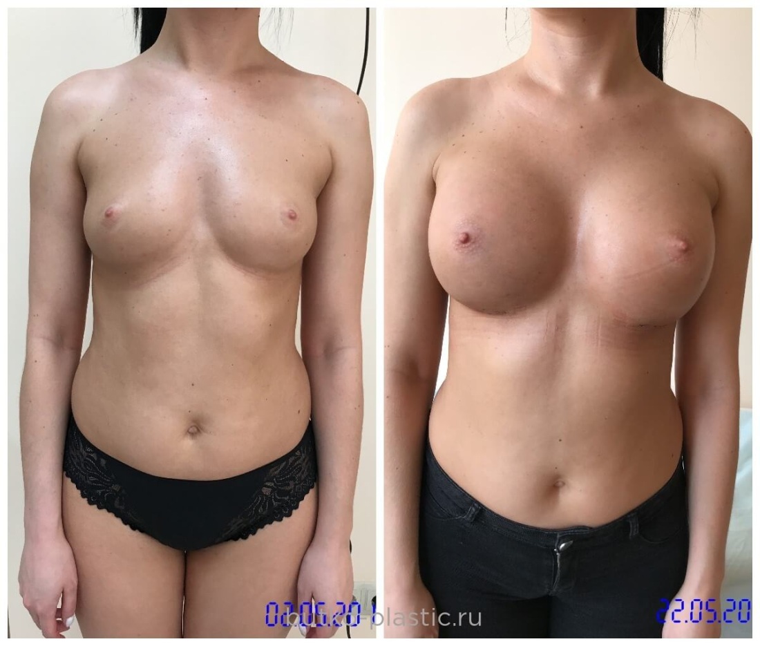 Подтяжка груди без имплантов