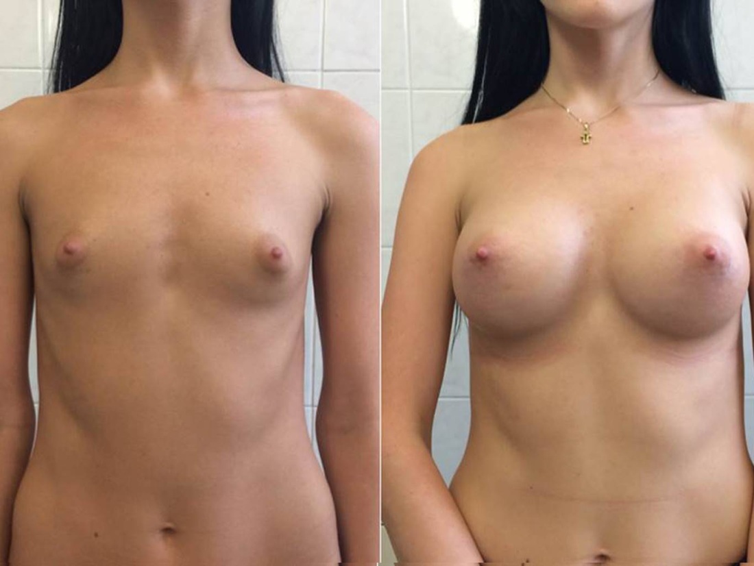 Пластика груди до и после