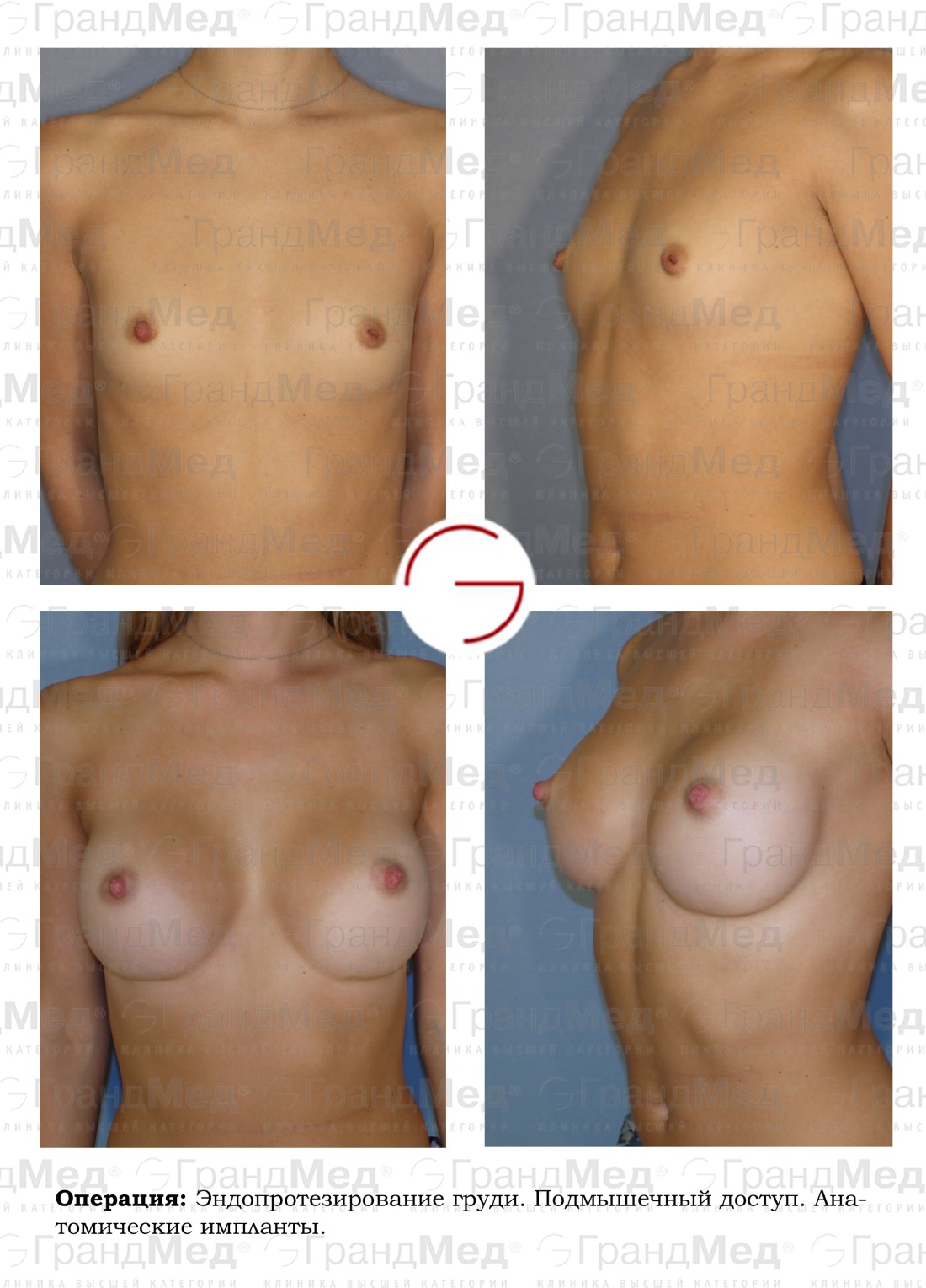 Как выглядит увеличенная грудь