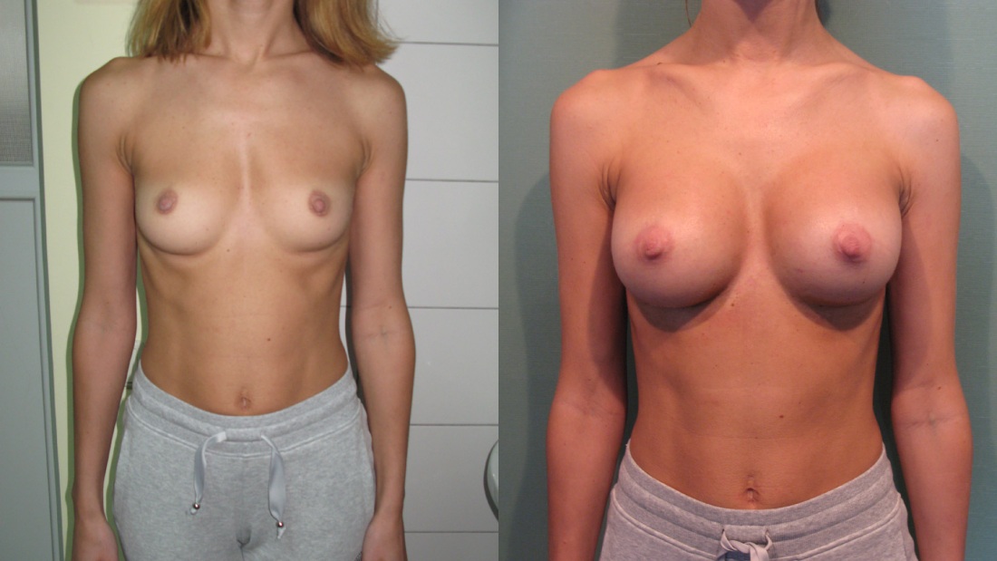 Пластика груди фото голые