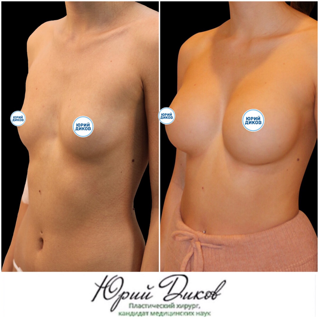 Этапы роста грудных желез фото