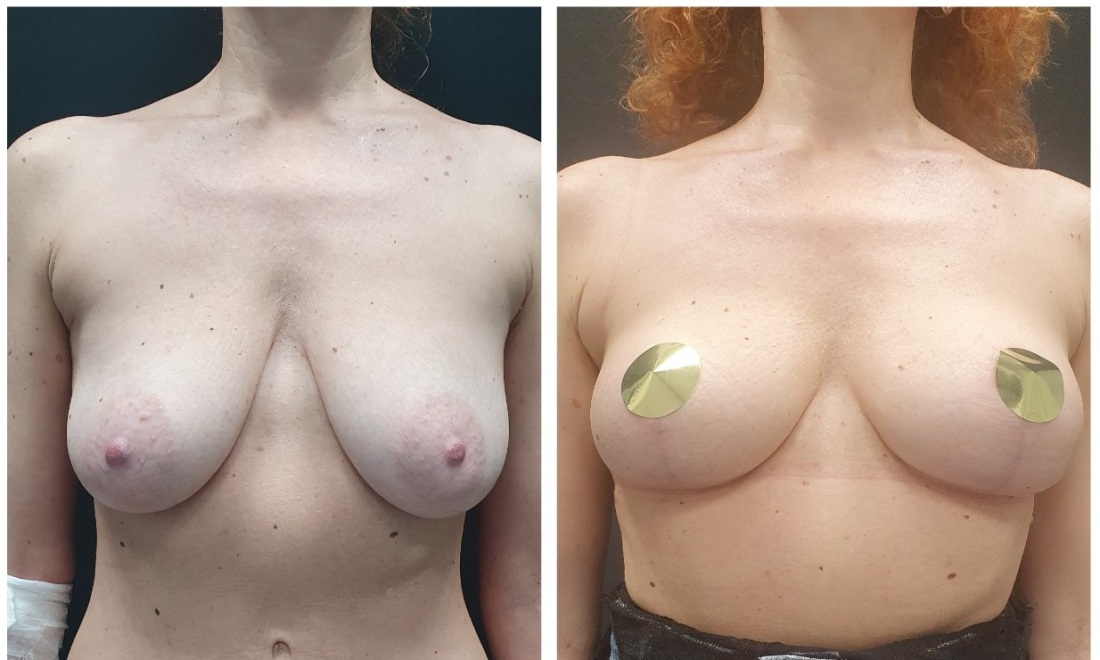 Неудачное увеличение грудных желез