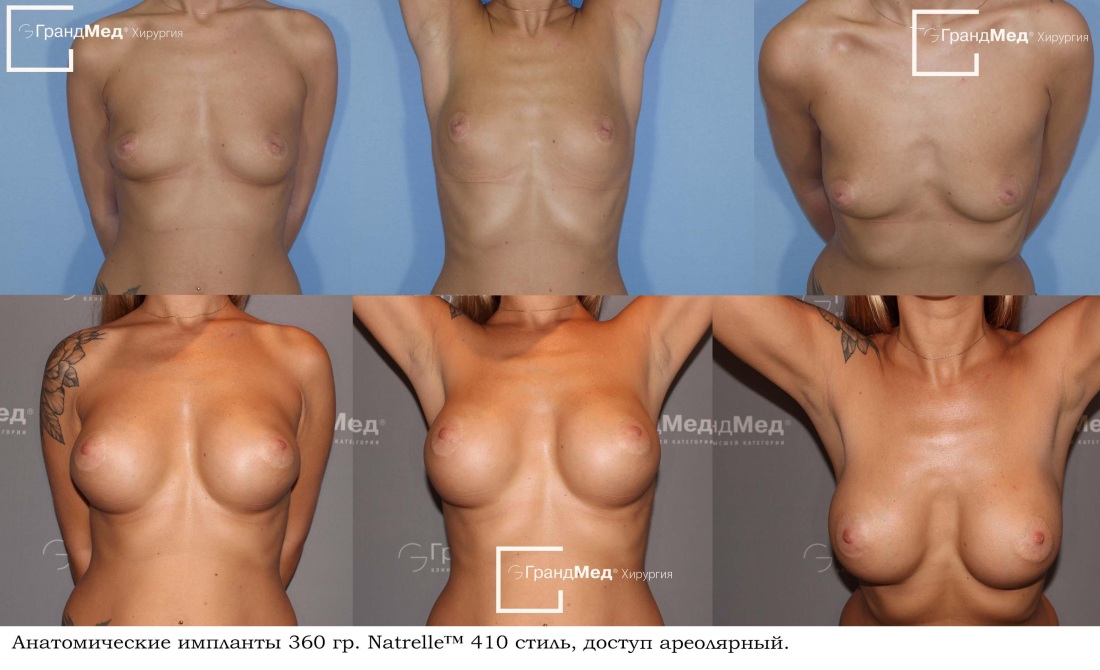 Голая грудь женщины увеличение