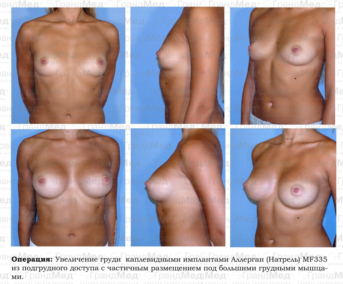 Грудь до и после имплантов