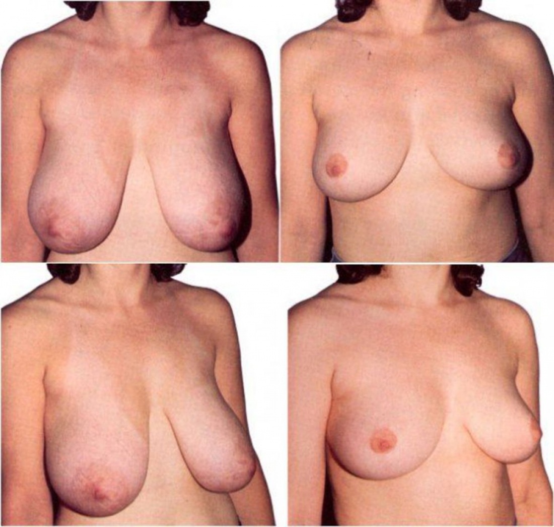 Грудь до и после операции