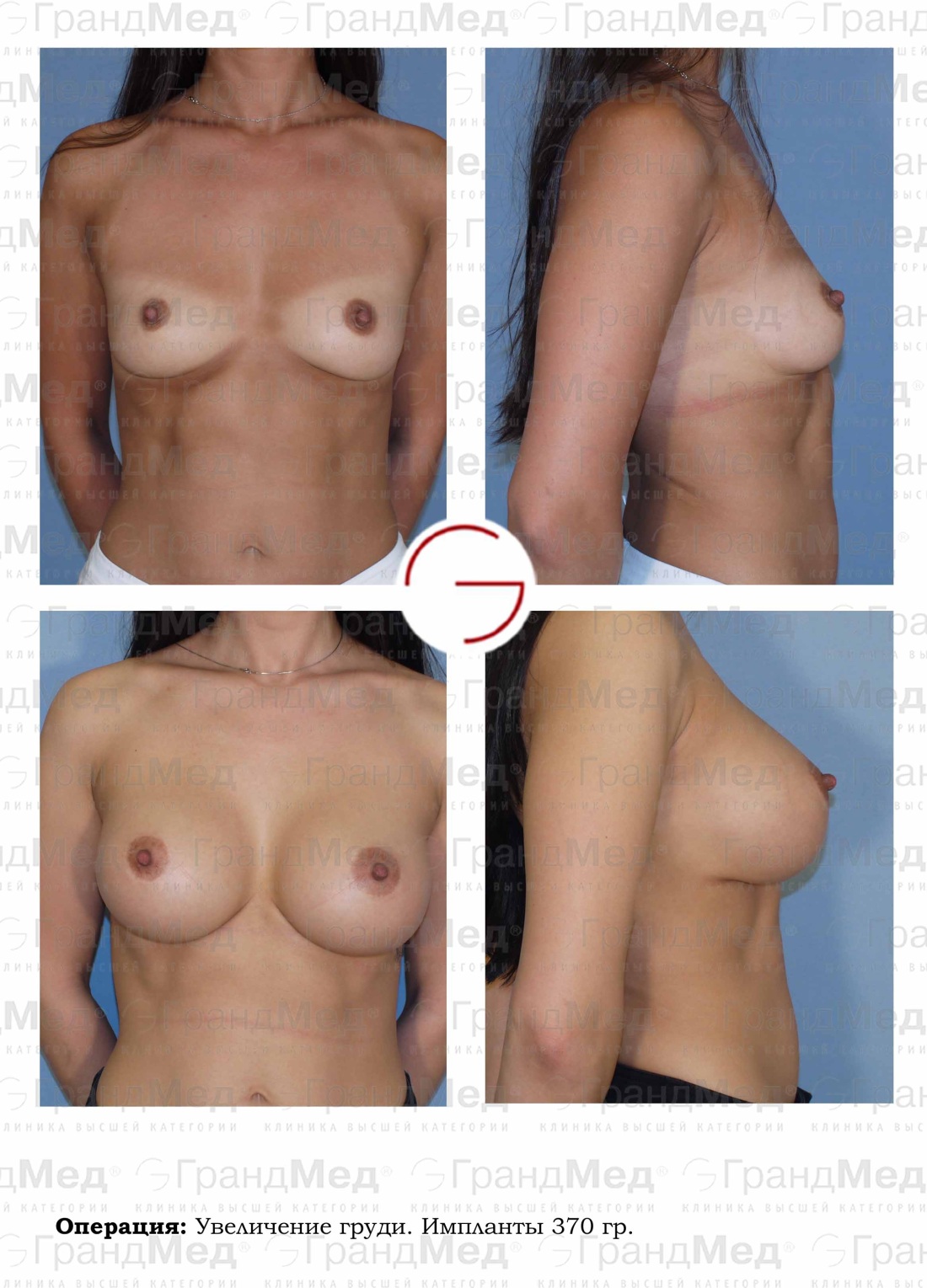 Грудь до и после маммопластики