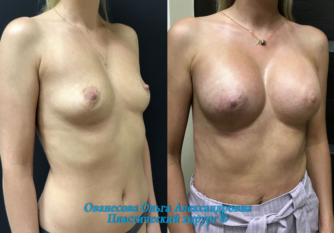 Несформированная грудь