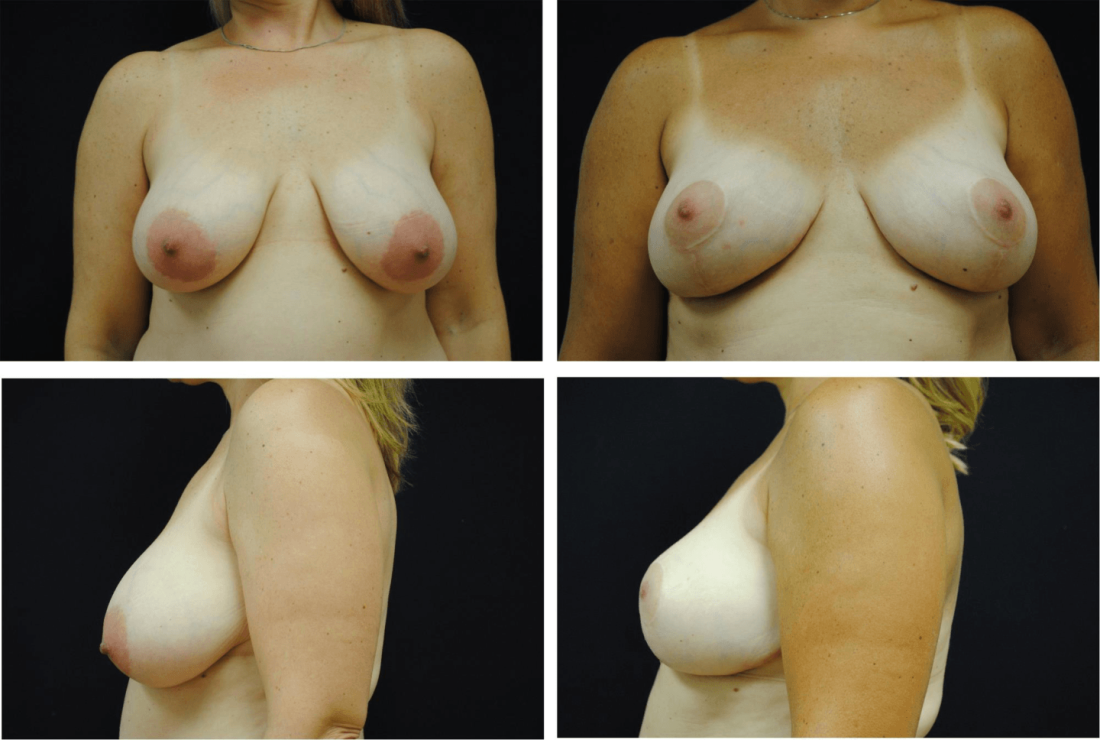 Обвисшая грудь 2 размера