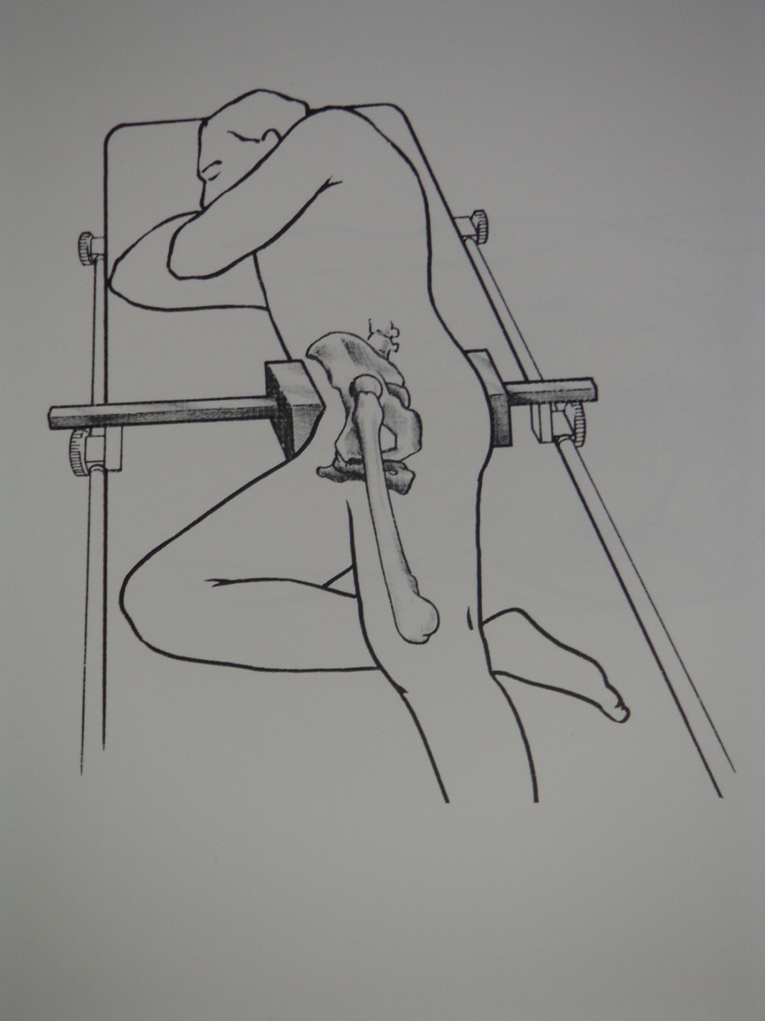 Манжетное вытяжение тазобедренного