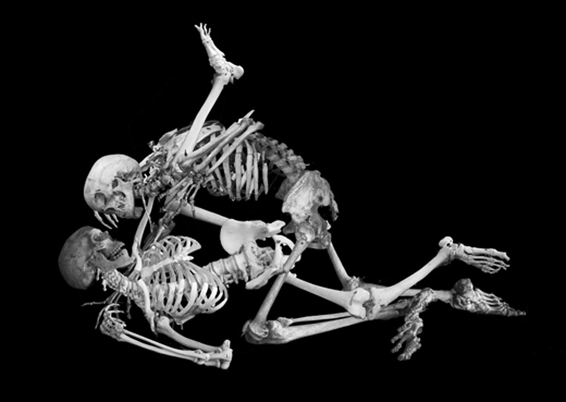 Скелет больного человека