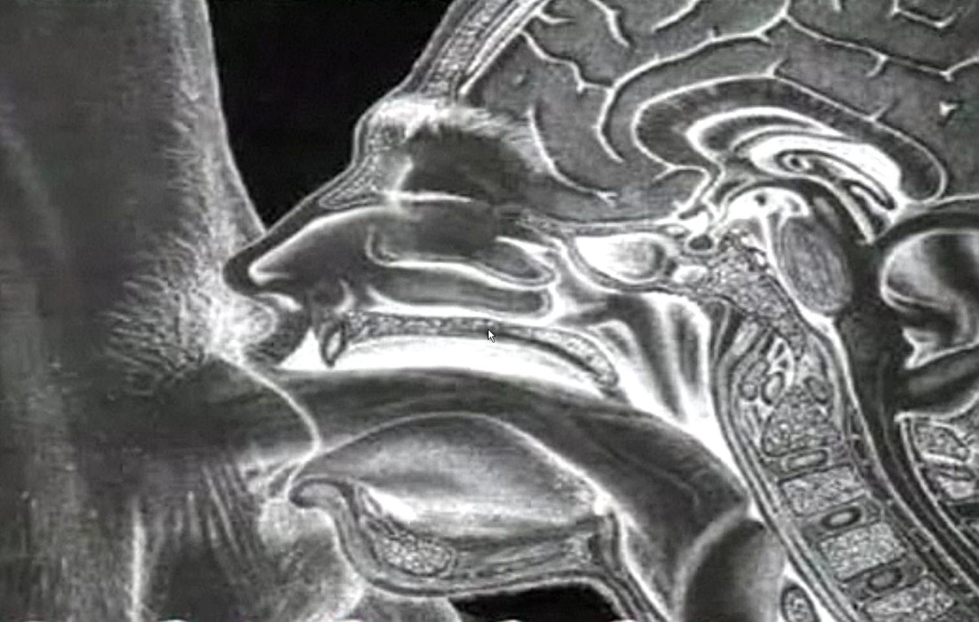 Влагалища в разрезе рентген