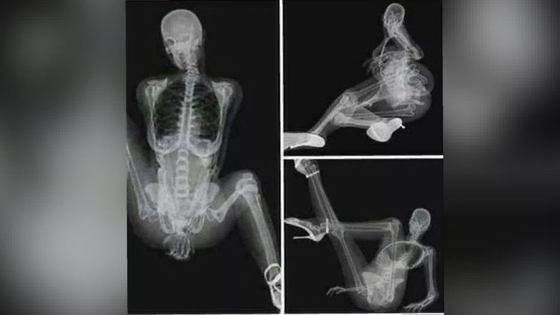 Рентгеновский снимок девушки