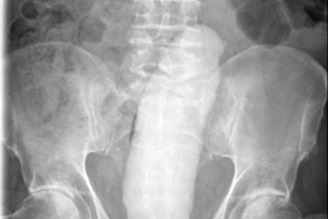 Рентгенограмма полового члена